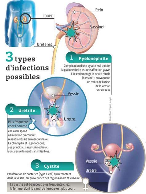 sodomie et infection urinaire|Comment éviter les infections urinaires à cause de la sodomie